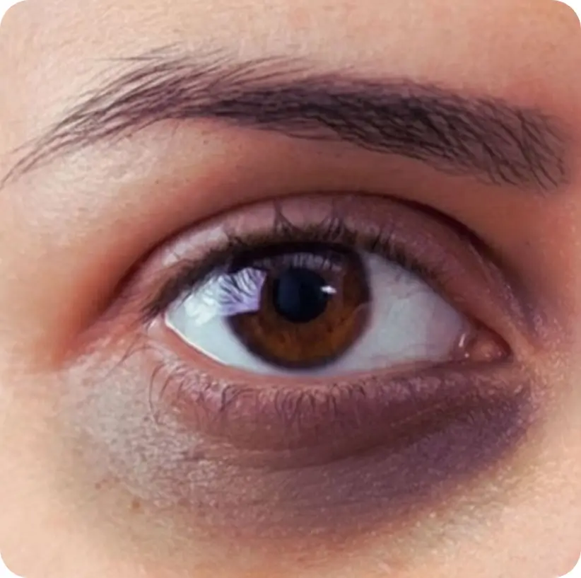 आँखों के निचे काले घेरे (Dark Circles)