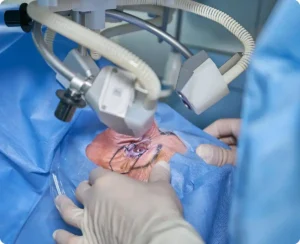 सफ़ेद मोतियाबिंद white cataract