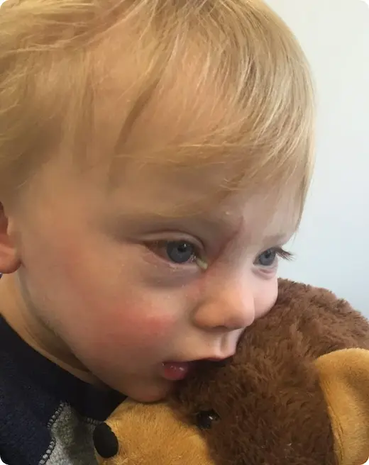 बच्चों की आँखों से कीचड़ आना