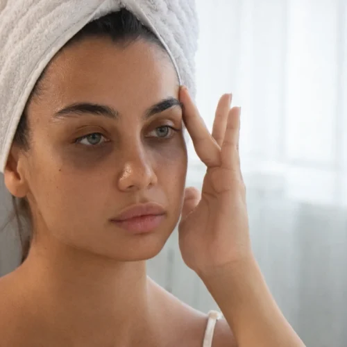 आँखों के निचे काले घेरे कारण और उपचार