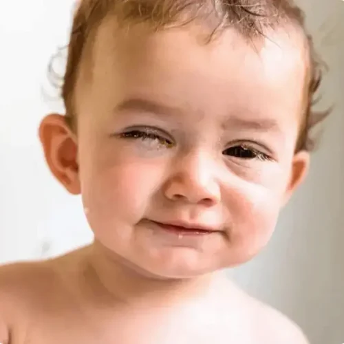 बच्चों की आँख से कीचड़ आना: कारण,लक्षण,रोकथाम और उपचार